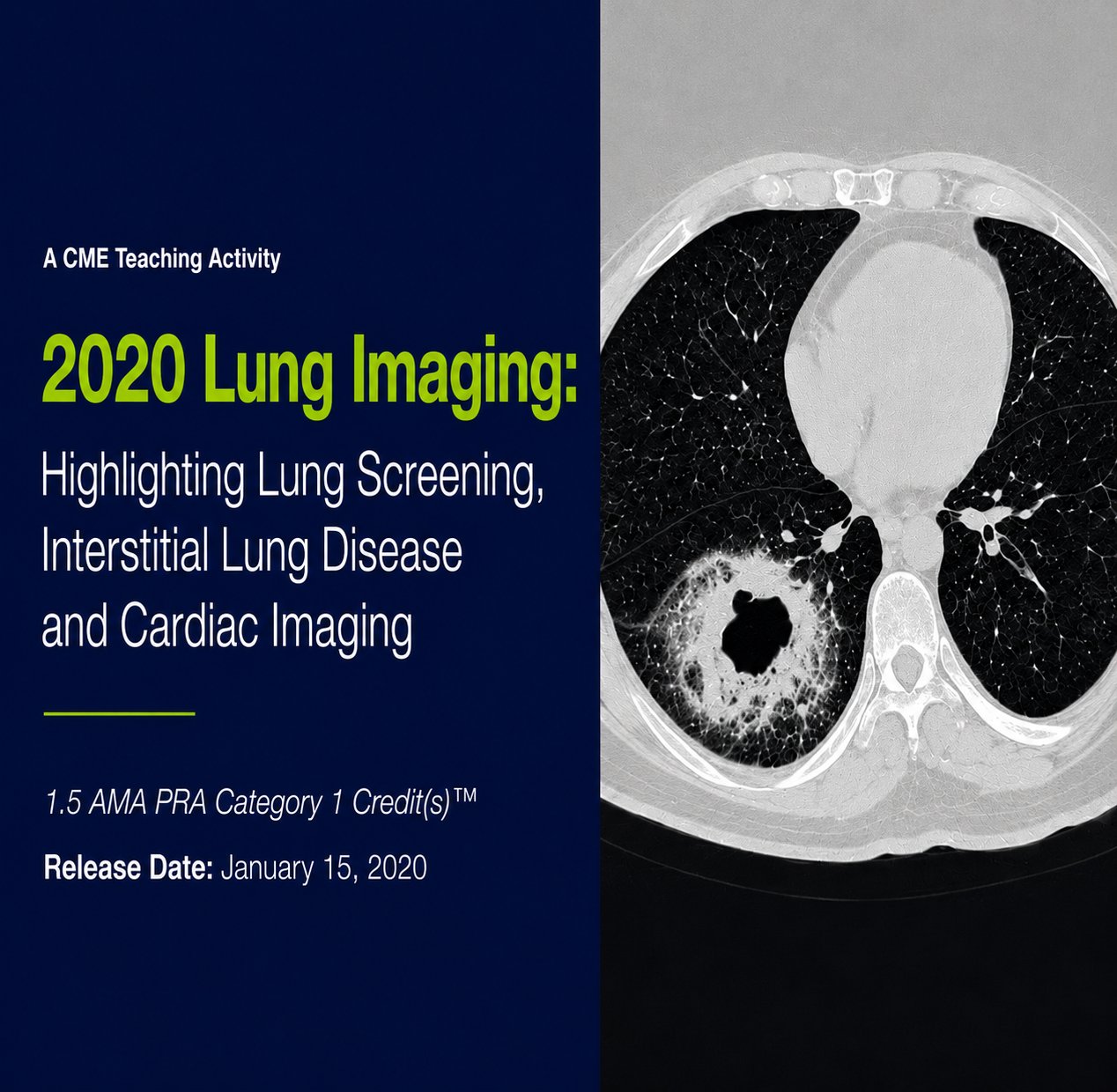 2020 Lung Imaging Highlighting Lung Cancer Screening and Interstitial Lung Disease 2020 Lung Imaging Highlighting Lung Cancer Screening and Interstitial Lung Disease