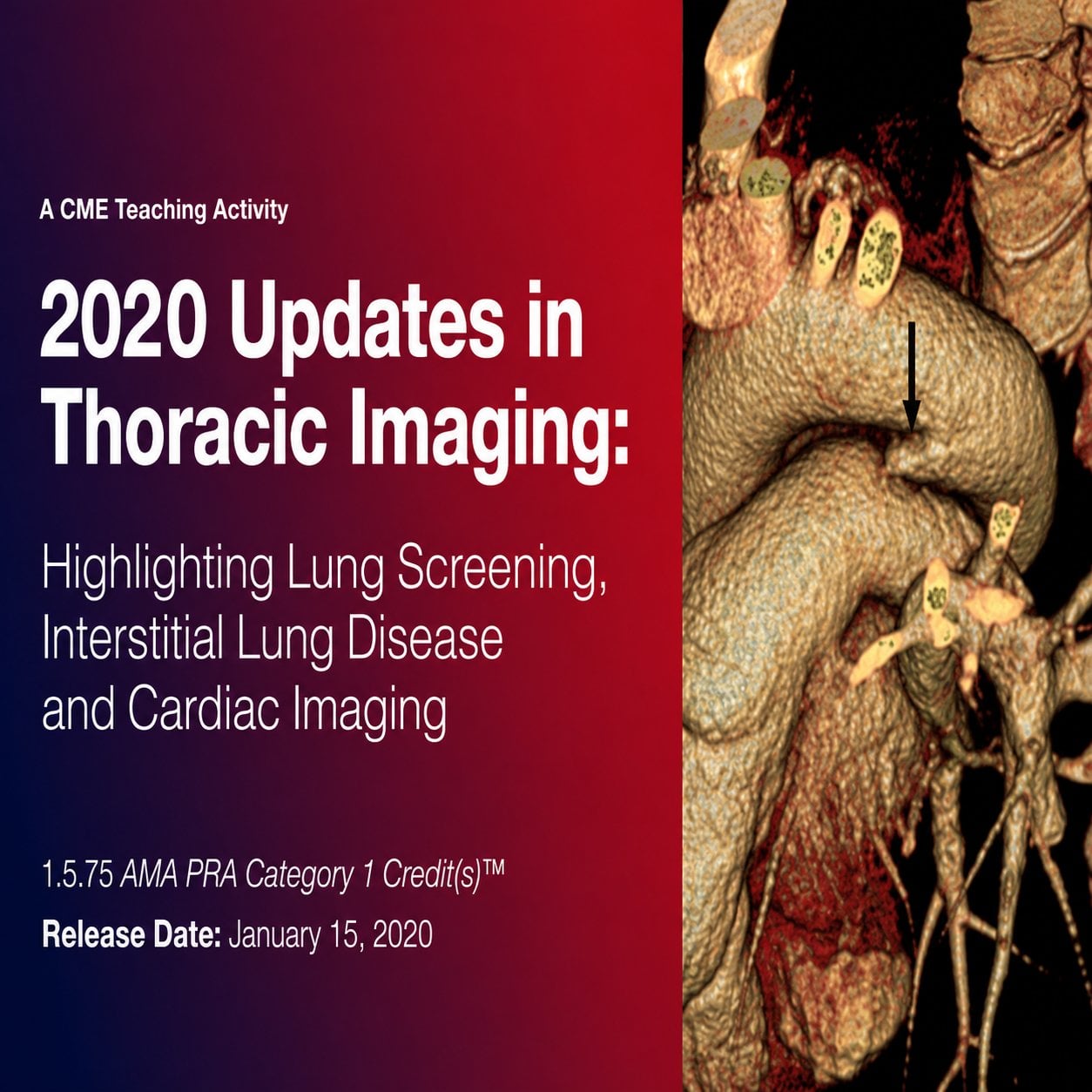 2020 Updates in Thoracic Imaging Highlighting Lung Screening, Interstitial Lung Disease, and Cardiac Imaging 2020 Updates in Thoracic Imaging Highlighting Lung Screening, Interstitial Lung Disease, and Cardiac Imaging