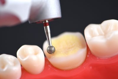 The Baard Institute Overlay, Onlay, & Advanced Adhesion The Baard Institute Overlay, Onlay, & Advanced Adhesion