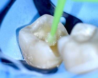 The Baard Institute Overlay, Onlay, & Advanced Adhesion The Baard Institute Overlay, Onlay, & Advanced Adhesion