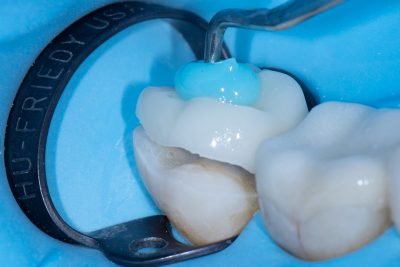 The Baard Institute Overlay, Onlay, & Advanced Adhesion The Baard Institute Overlay, Onlay, & Advanced Adhesion