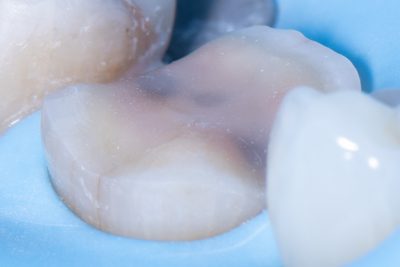 The Baard Institute Overlay, Onlay, & Advanced Adhesion The Baard Institute Overlay, Onlay, & Advanced Adhesion