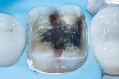 The Baard Institute Overlay, Onlay, & Advanced Adhesion The Baard Institute Overlay, Onlay, & Advanced Adhesion
