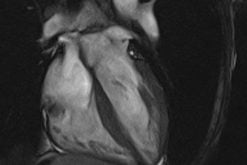 MRIOnline Mastery Series Cardiac MRI of Non Ischemic Cardiomyopathy 2021 CME VIDEOS