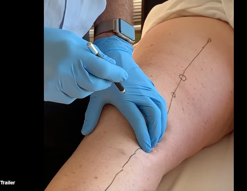 Lyftogt Perineural Injection Treatment videos: Knee collection Lyftogt Perineural Injection Treatment videos: Knee collection