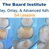 The Baard Institute Overlay, Onlay, & Advanced Adhesion The Baard Institute Overlay, Onlay, & Advanced Adhesion