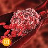 Thrombosis & Thromboembolism 2022 Thrombosis Thromboembolism 2022 CME VIDEOS