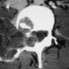 MRI Mastery Series: Degenerative Joint Disease (DJD) 2020 screen shot 2020 07 21 at 3 510x352 1