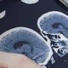 Radiopaedia NEURORADIOLOGY UPDATE COURSE Videos telechargement