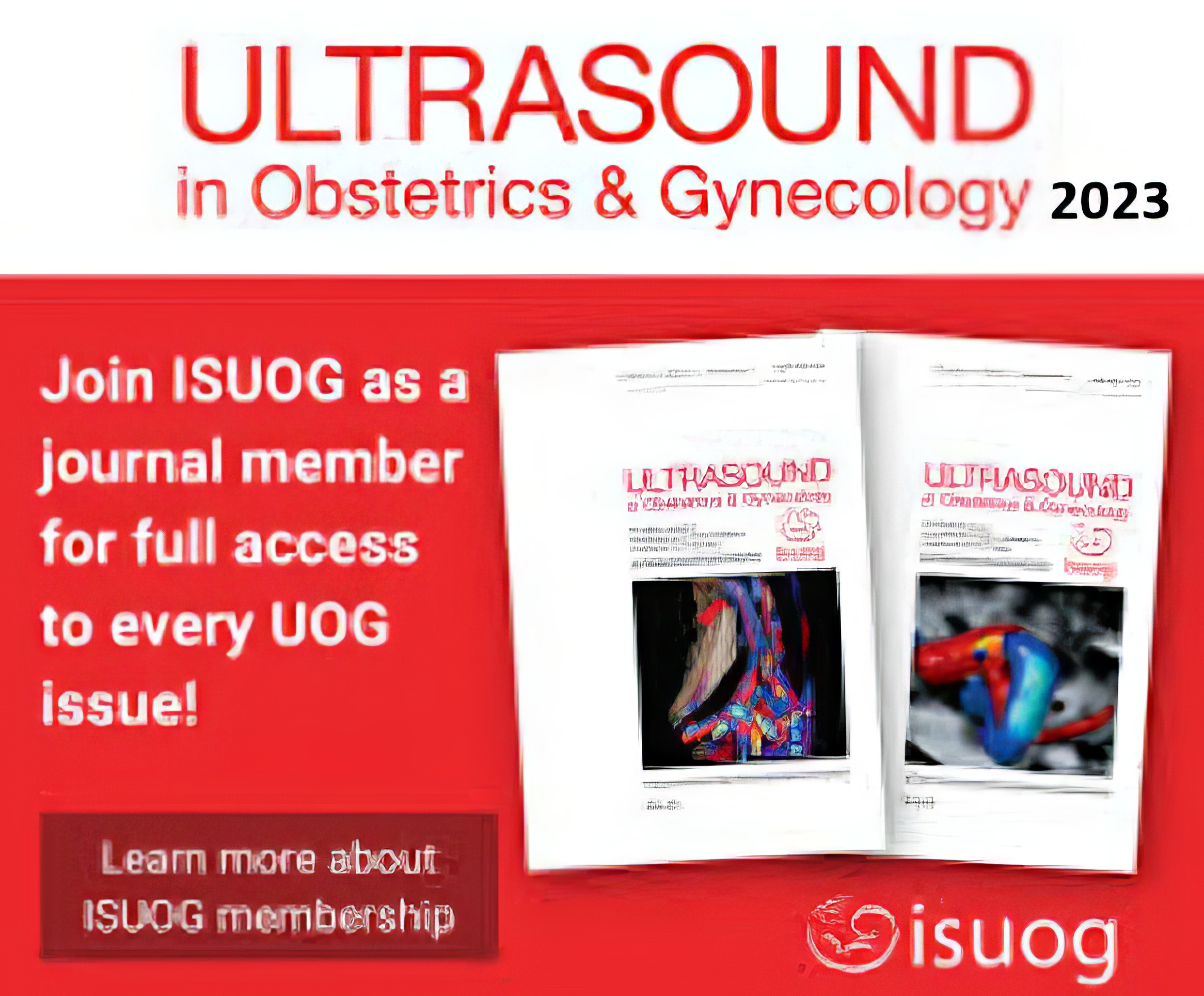 Ultrasound in Obstetrics & Gynecology 2023 Full Archives (True PDF) Ultrasound in Obstetrics & Gynecology 2023 Full Archives (True PDF)