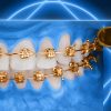 OHI-S Impaction Treatment Author’s Protocols, Mistakes and Solutions OHI-S Impaction Treatment Author’s Protocols, Mistakes and Solutions