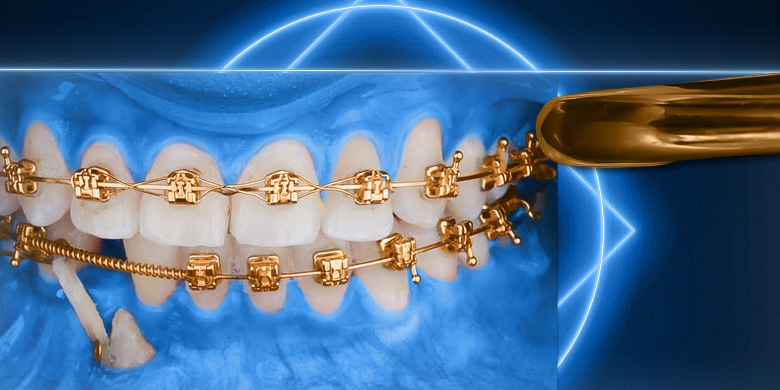 OHI-S Impaction Treatment Author’s Protocols, Mistakes and Solutions OHI-S Impaction Treatment Author’s Protocols, Mistakes and Solutions