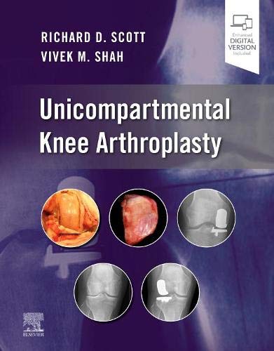 Unicompartmental Knee Arthroplasty (Original PDF from Publisher) Unicompartmental Knee Arthroplasty (Original PDF from Publisher)