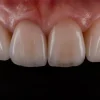 OHI-S Ceramic Veneers Interdisciplinary Approach and Updated Protocols OHI-S Ceramic Veneers Interdisciplinary Approach and Updated Protocols