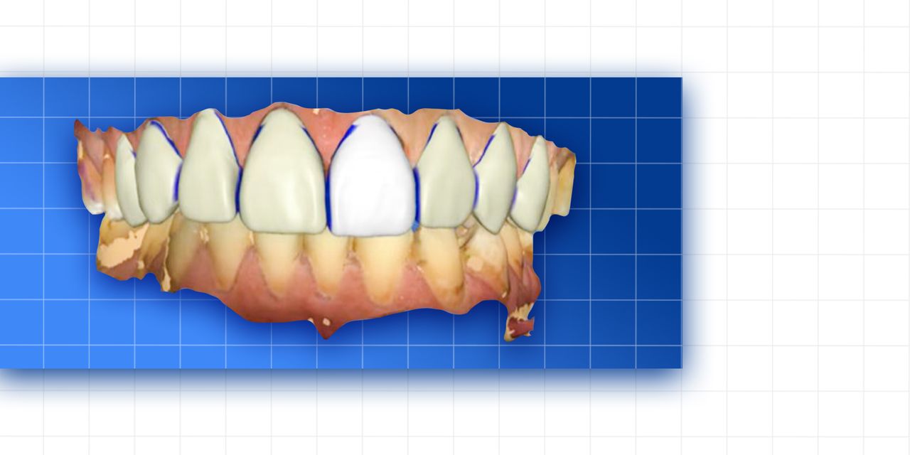 OHI-S Complete prosthetic protocols CADCAM CEREC OHI-S Complete prosthetic protocols CADCAM CEREC