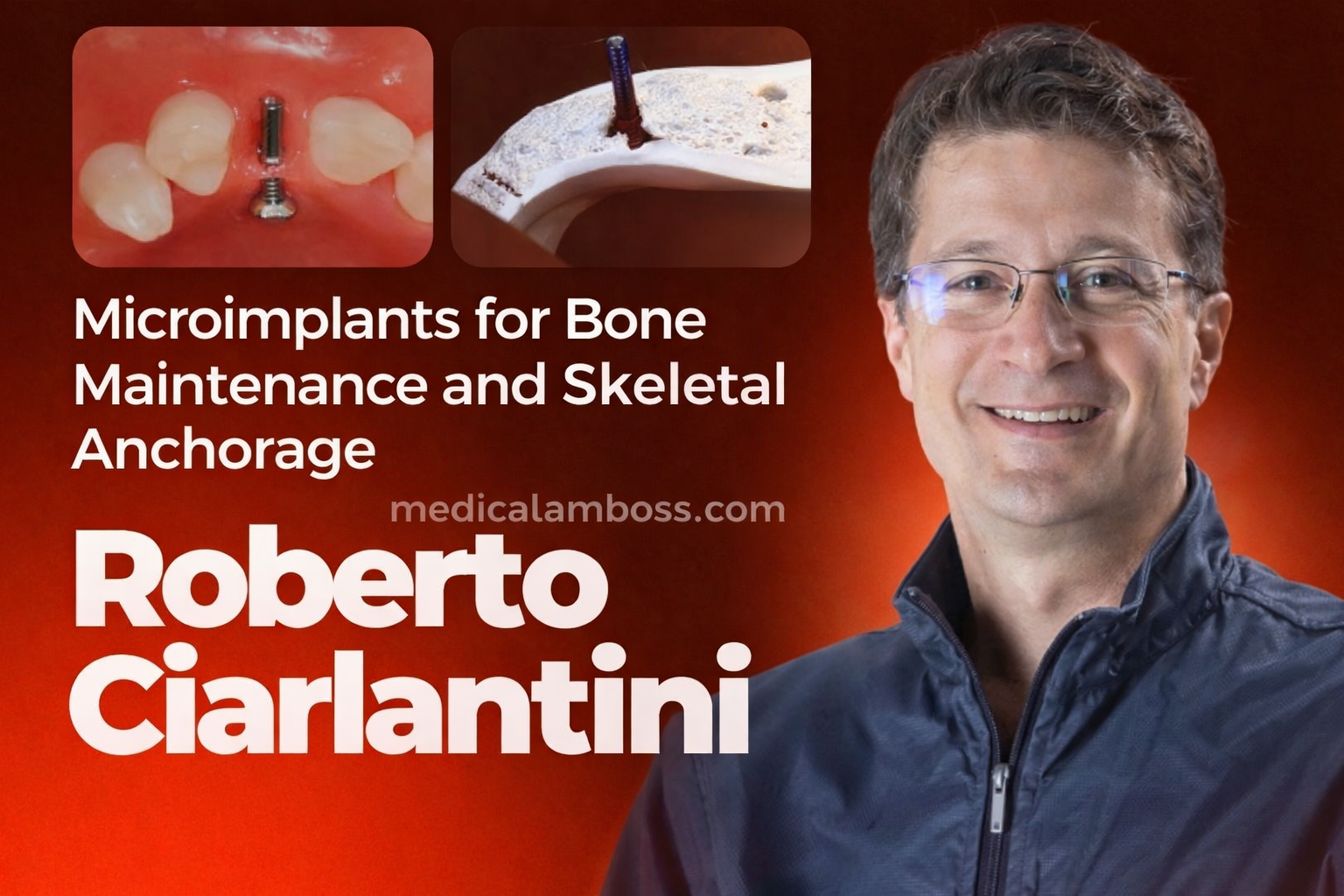 OHI-S Microimplants as Bone Maintainers and Skeletal Anchorage Insertion Protocols OHI-S Microimplants as Bone Maintainers and Skeletal Anchorage Insertion Protocols