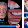 Ceramic Veneers Workflow Ceramic Veneers Workflow