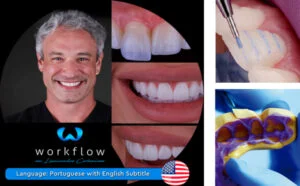 Ceramic Veneers Workflow Ceramic Veneers Workflow