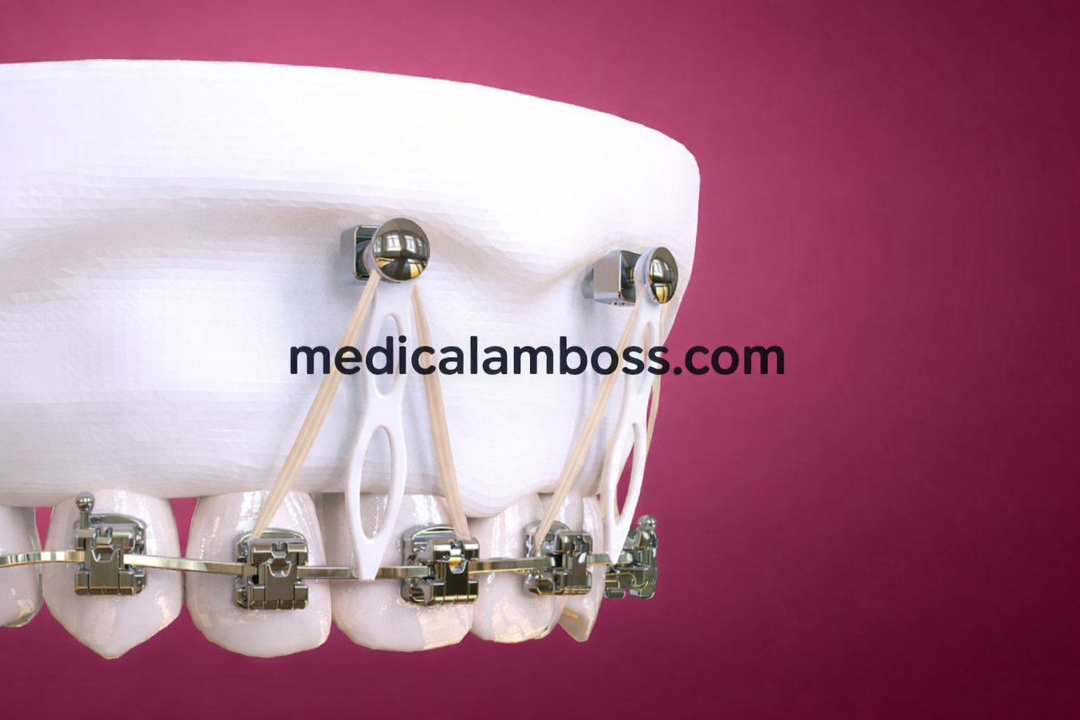 OHI-S Microimplant Anchorage in Clinical Practice Guide for Beginners and Intermediate OHI-S Microimplant Anchorage in Clinical Practice Guide for Beginners and Intermediate