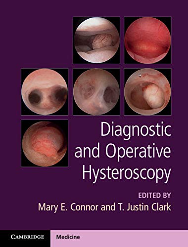 Diagnostic and Operative Hysteroscopy (Original PDF from Publisher + Videos) Diagnostic and Operative Hysteroscopy (Original PDF from Publisher + Videos)