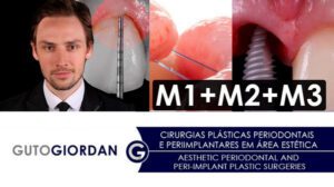 Aesthetic Periodontal and Peri-Implant Plastic Surgeries Portugase with English Aesthetic Periodontal and Peri-Implant Plastic Surgeries Portugase with English