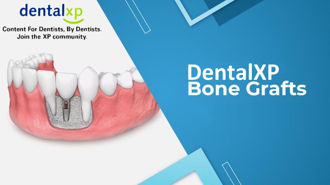 DentalXP Bone Grafts DentalXP Bone Grafts