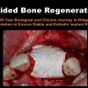 Guided Bone Regeneration: A 30 year Biological and Clinical Journey in Ridge Augmentation Guided Bone Regeneration: A 30 year Biological and Clinical Journey in Ridge Augmentation