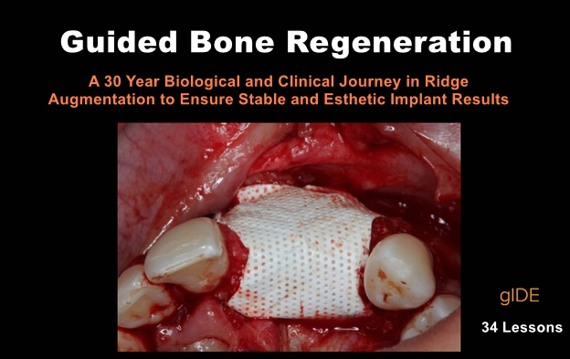 Guided Bone Regeneration: A 30 year Biological and Clinical Journey in Ridge Augmentation Guided Bone Regeneration: A 30 year Biological and Clinical Journey in Ridge Augmentation