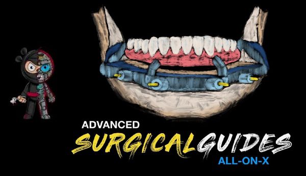Implant Ninja, Advanced Surgical Guides – All on X – Dental Videos Implant Ninja, Advanced Surgical Guides – All on X – Dental Videos