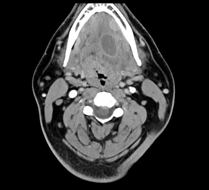 MRIOnline Imaging Mastery Series: Pathology of the Oral Cavity and Oropharynx 2020 (CME VIDEOS) MRIOnline Imaging Mastery Series: Pathology of the Oral Cavity and Oropharynx 2020 (CME VIDEOS)