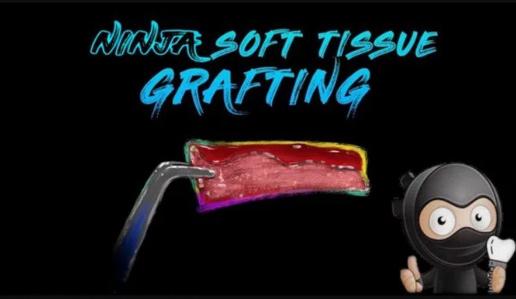 Ninja Soft Tissue Grafting Ninja Soft Tissue Grafting