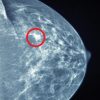 UCSF Breast Imaging 2022