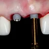 Gidental Online Residency Program: A-Z in Implant Dentistry