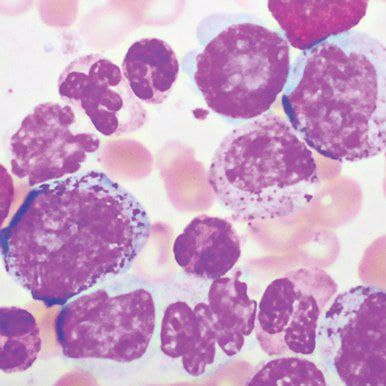 Hematopathology 2021 Hematopathology 2021