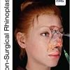 Non-Surgical Rhinoplasty (The PRIME Series) (Original PDF from Publisher) Non-Surgical Rhinoplasty (The PRIME Series) (Original PDF from Publisher)