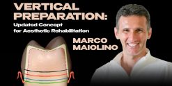 OHI-S Vertical Preparation Updated Concept for Aesthetic Rehabilitation 17 lessons 8h 44m