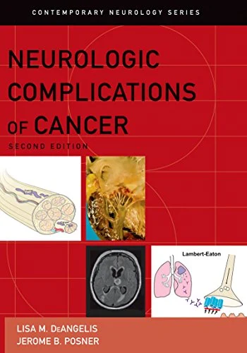 Neurologic Complications of Cancer (Contemporary Neurology Series Book 73), 2nd edition (Original PDF from Publisher) Neurologic Complications of Cancer (Contemporary Neurology Series Book 73), 2nd edition (Original PDF from Publisher)