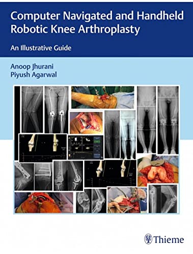 Computer Navigated and Handheld Robotic Knee Arthroplasty: An Illustrative Guide (Original PDF from Publisher) Computer Navigated and Handheld Robotic Knee Arthroplasty