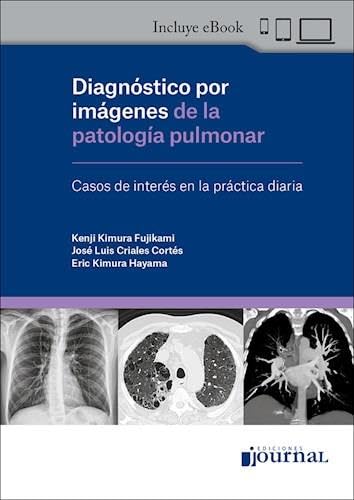 Diagnóstico por Imágenes de la Patología Pulmonar. Casos de Interés en la Práctica Diaria (Original PDF from Publisher) Diagnóstico por Imágenes de la Patología Pulmonar. Casos de Interés en la Práctica Diaria (Original PDF from Publisher)