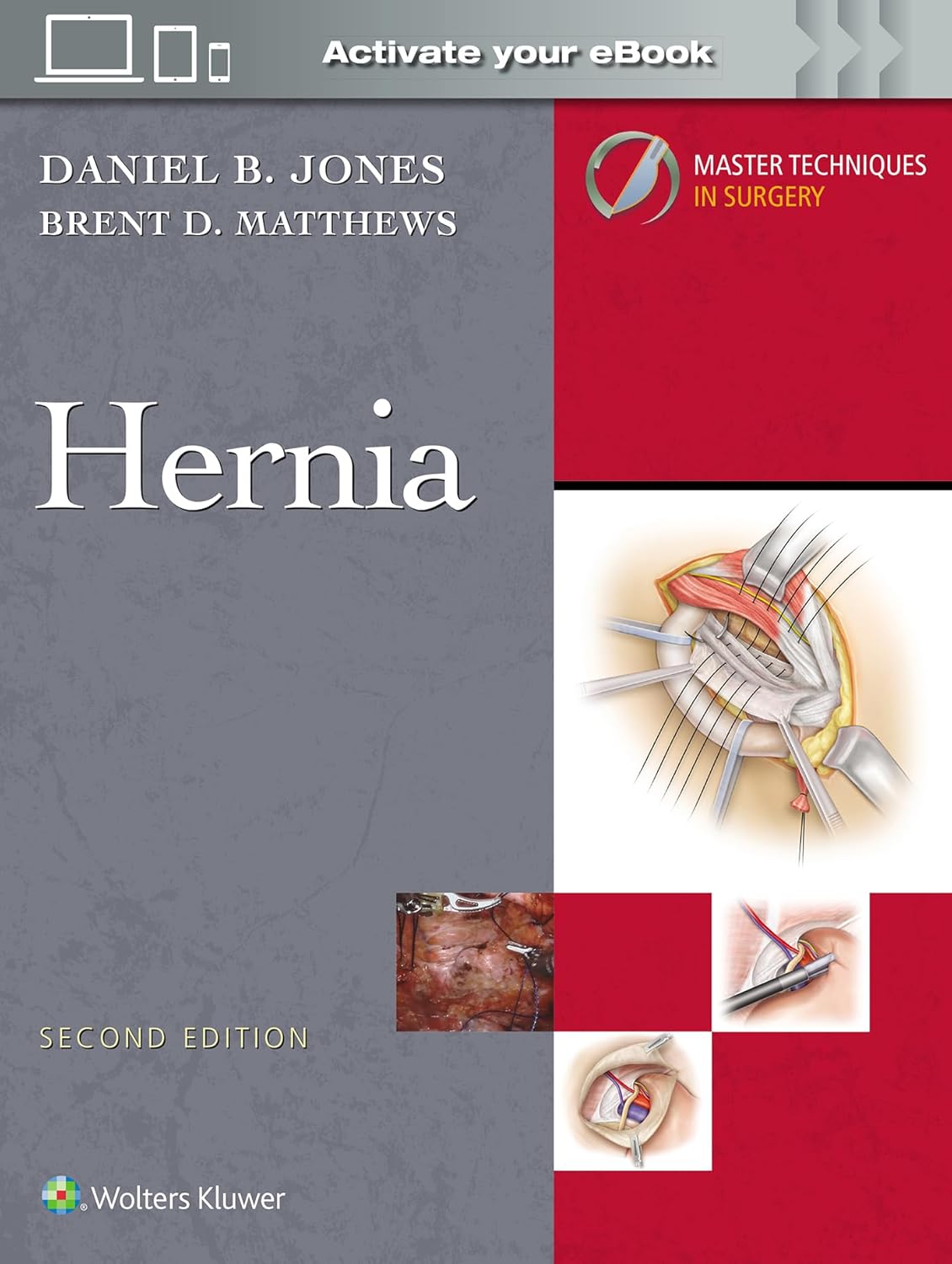 Master Techniques in Surgery: Hernia, 2nd Edition (Videos only) Master Techniques in Surgery: Hernia, 2nd Edition (Videos only)